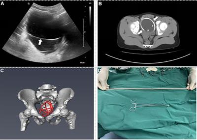 Foreign bodies in children's lower urinary tract: A case series and literature review